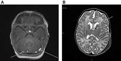 Prevalence and Risk Factors of Incidental Findings in Brain MRIs of Healthy Neonates—The FinnBrain Birth Cohort Study